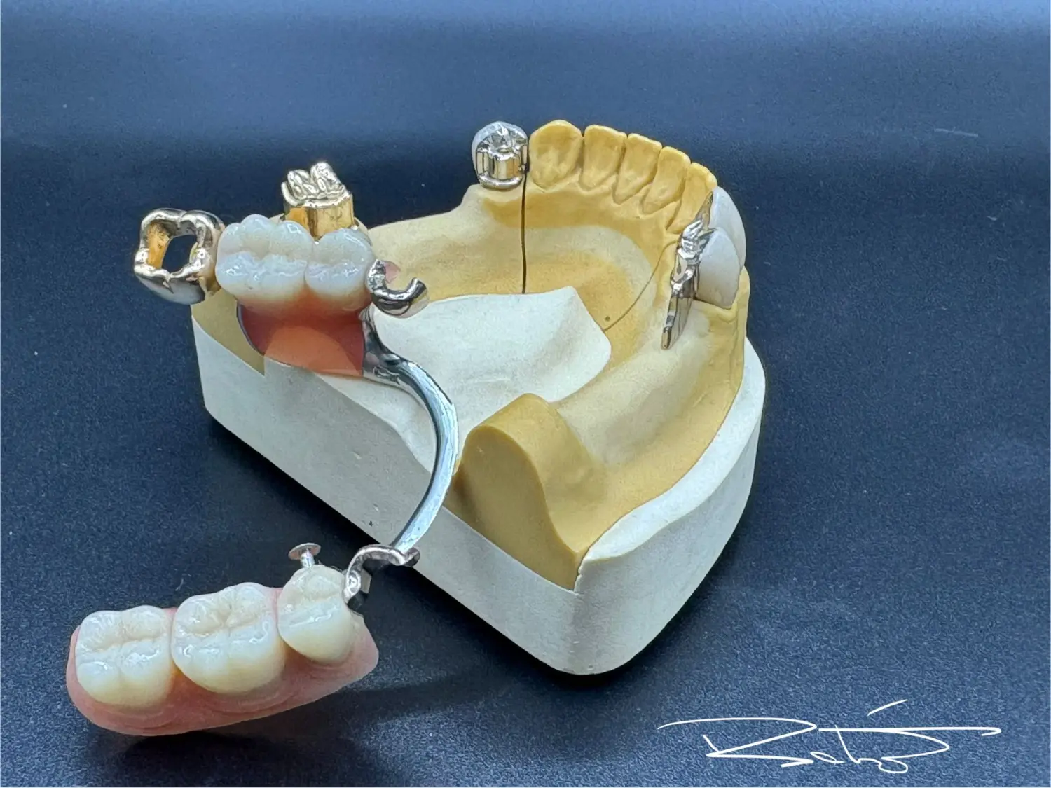herausnehmbare Teilprothese der Dental Ästhetik Eberhardt GmbH