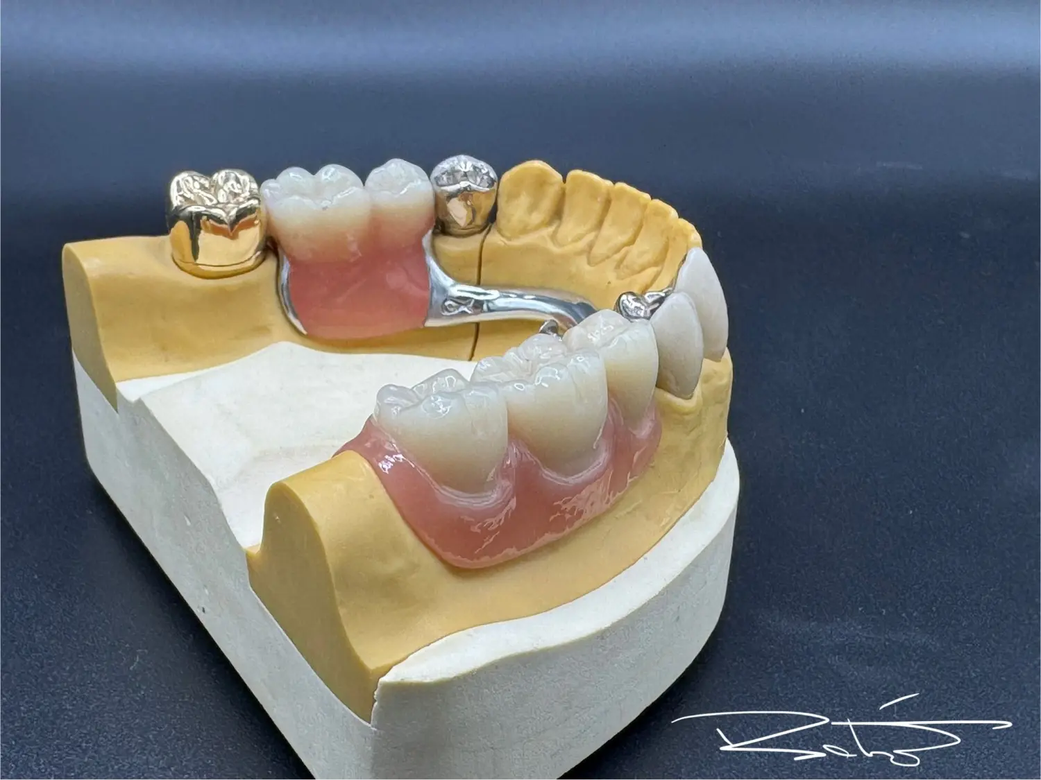 herausnehmbare Teilprothese der Dental Ästhetik Eberhardt GmbH