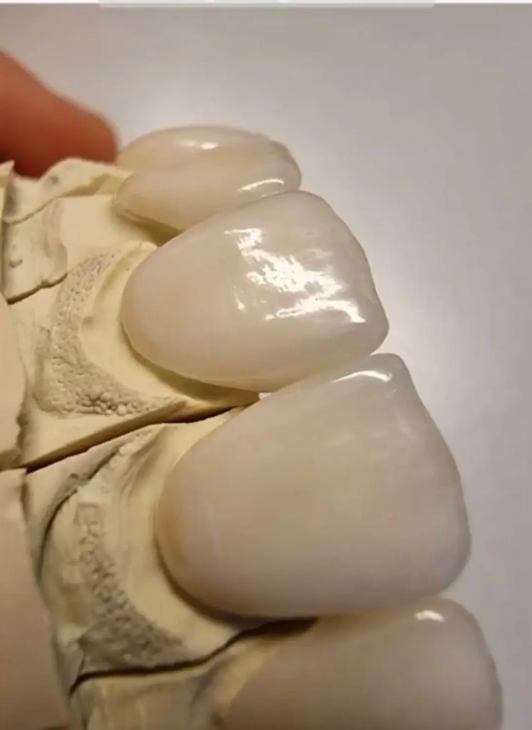 Veneers von Dental Ästhetik Eberhardt GmbH