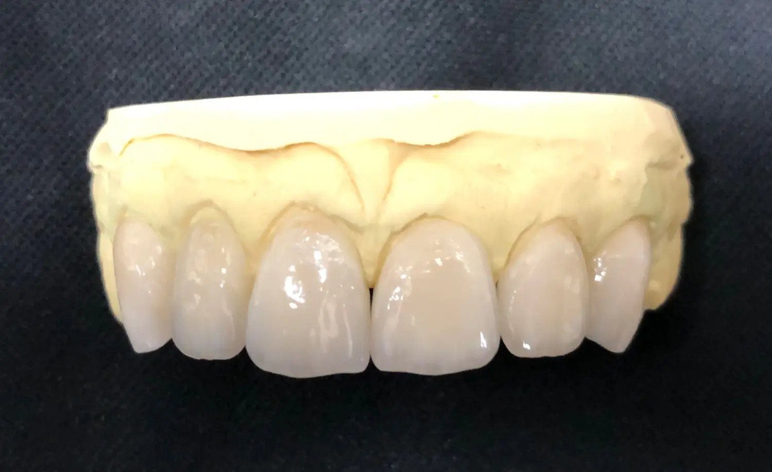 Veneers von Dental Ästhetik Eberhardt GmbH