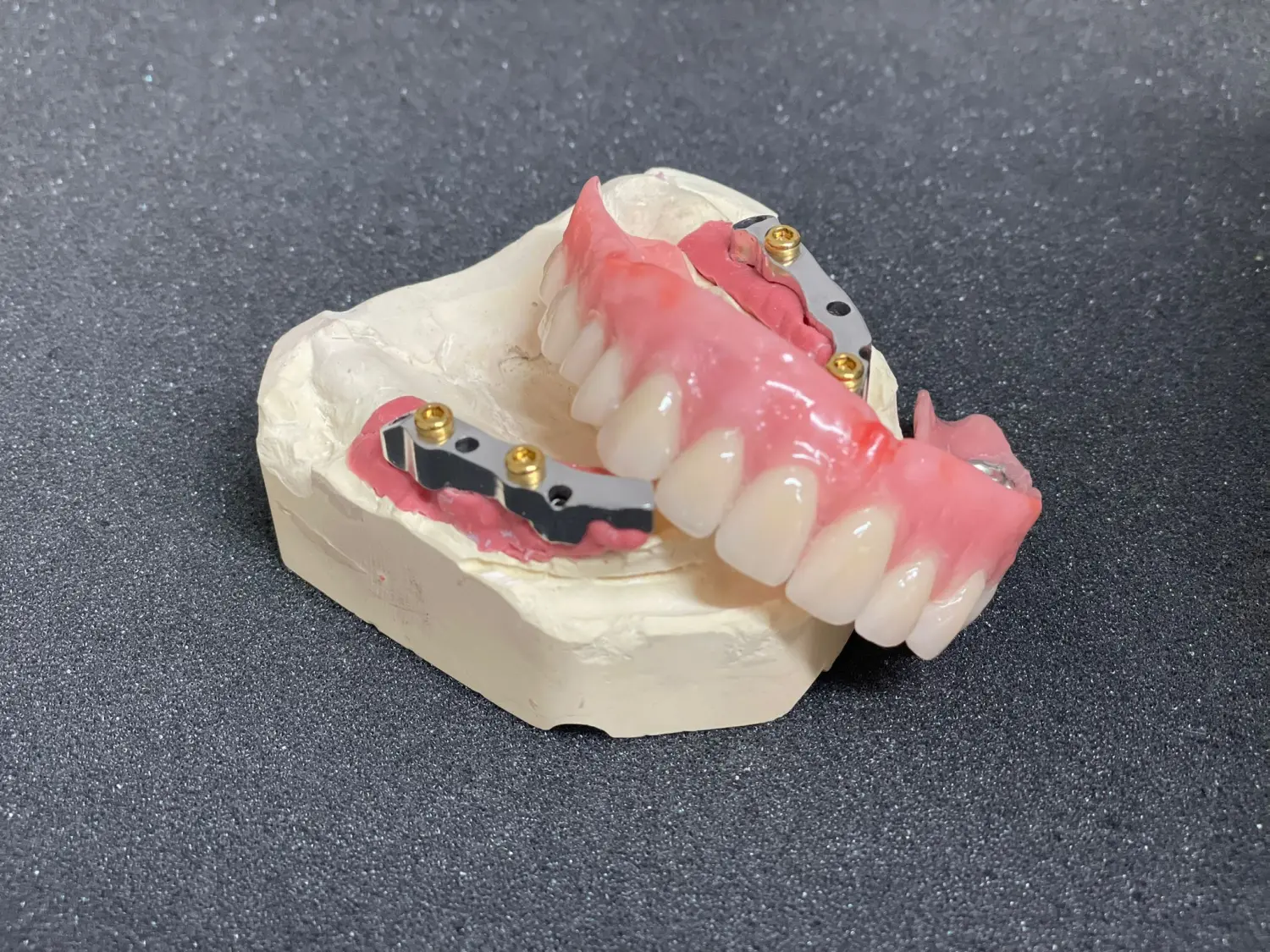 Implantatunterstützte Prothesen der Dental Ästhetik Eberhardt GmbH