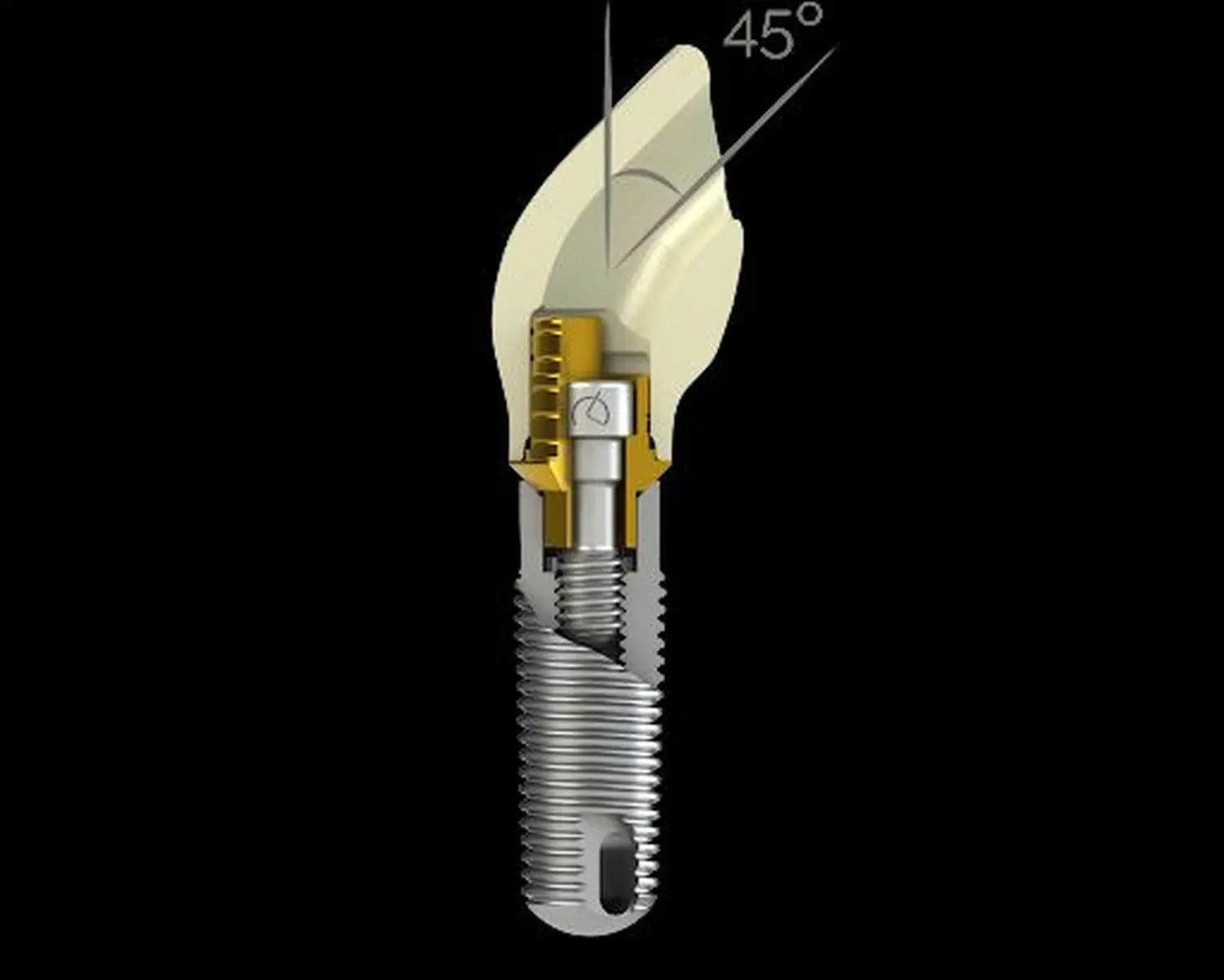 Verschraubte Krone von Dental Ästhetik Eberhardt GmbH