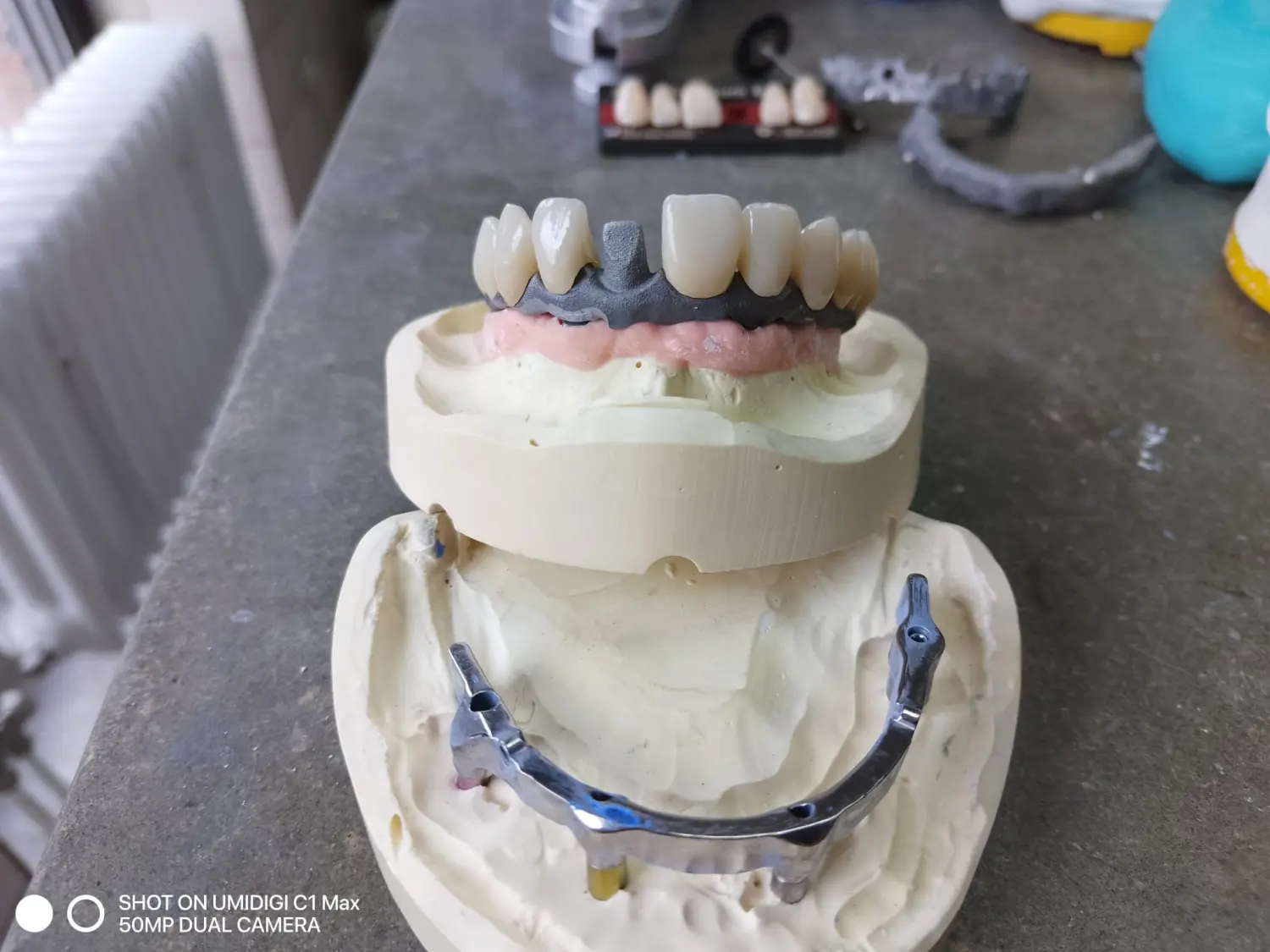 Implantatunterstützte Prothesen der Dental Ästhetik Eberhardt GmbH