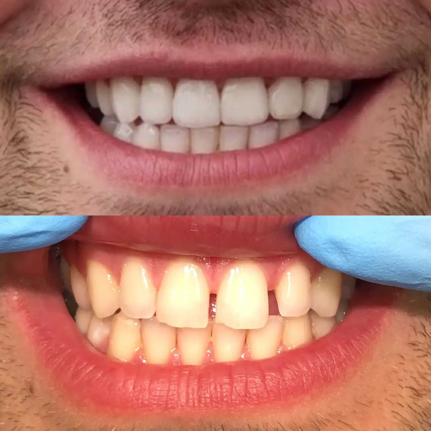 Veneers von Dental Ästhetik Eberhardt GmbH