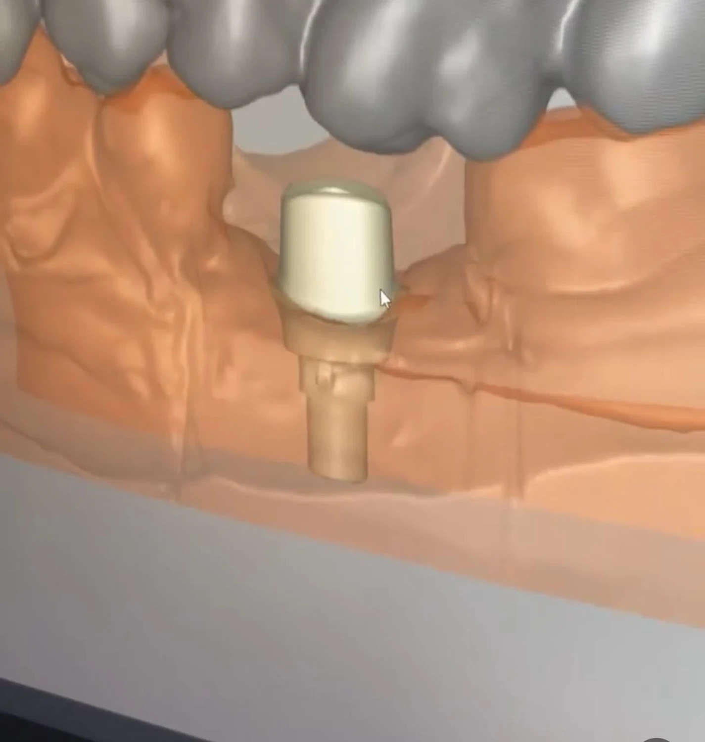Individuelle Abutments von Dental Ästhetik Eberhardt GmbH