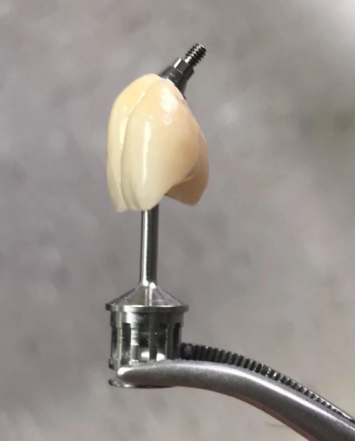 Verschraubte Krone von Dental Ästhetik Eberhardt GmbH